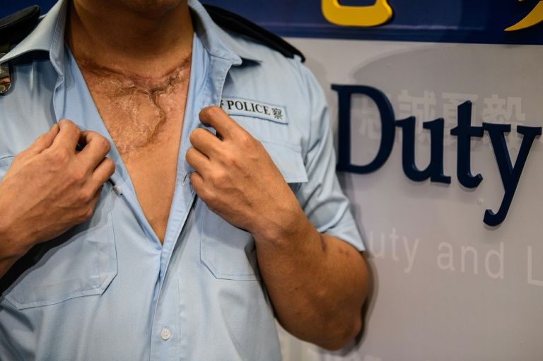 Hong Kong policeman, who asked to be identified as Ling, was struck by corrosive liquid on October 1 when unrest swept through the city on China's National Day. (AFP Photo/Anthony WALLACE)